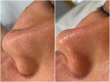 ジョアアンジェ 京橋店(joie ange)/ハーブピーリングで毛穴洗浄