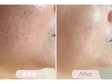 エピル(EPIL)/DEEPクリアスキン毛穴洗浄症例