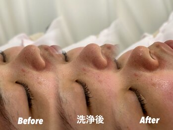 クイーン 渋谷店(QUEEN)/頑固な毛穴つまり