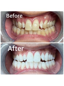 シャイニング 岩出店(SHINING)/ハイブリッドホワイトニング