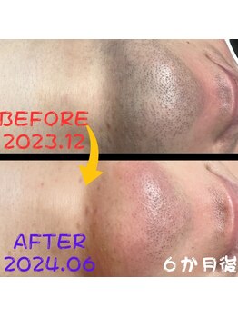 フェリッセ(FELISSE)/濃いヒゲ ビフォーアフター