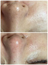 リンカ(Rinca)/毛穴ケア結果がすごい！毛穴悩み