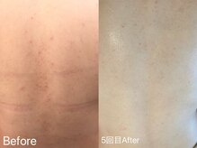 リンダ 西宮店(LINDA)/背中美人♪