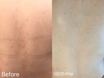 リンダ 西宮店(LINDA)/背中美人♪