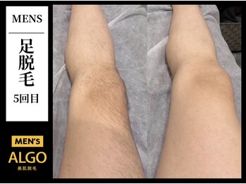 アルゴ 小倉守恒店(ALGO)/足脱毛