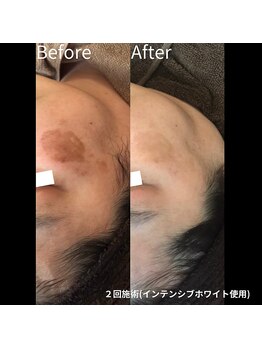 プレイス 堂山本店(PLACE)/ハーブピーリング