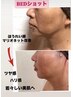 最強小顔　REDショット充実コースにVlL小顔マッサージ付