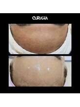 モアナ(Moana)/before┃after