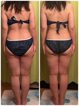 ヨサ パーク コアハート(YOSA PARK CORE HEART)/45歳後半１回の効果