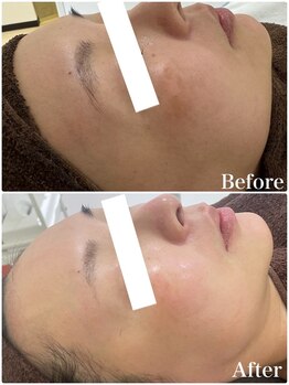 パールホワイトニングサロン 平塚店/最新韓国ピーリング/はりつやUP