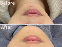 グレース 吉祥寺(grace)/跡を残さない毛穴ケア/吉祥寺