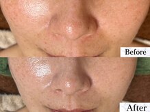 サロン ド エン(Salon de. en)/乾燥毛穴ケア◇ハーブピーリング