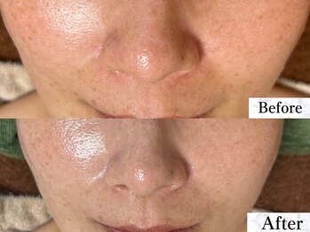 サロン ド エン(Salon de. en)/乾燥毛穴ケア◇ハーブピーリング