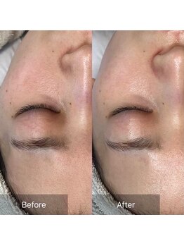 ホリシア 博多(HORISHIA)/ララピール/毛穴/ニキビケア