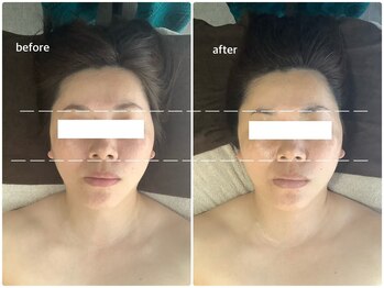 アベリア リュウ(Aberia Lieu)/頭蓋小顔矯正/小顔矯正