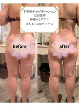 アマンジオ/オットー 新居浜店(amanjiwo/Otto)/キャビテーション・Before/After