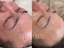 ムーム なんば店(moom)/日本初OPLを使い深い線や毛穴に