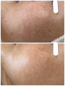 アンド ユー(and.yu)/40代/シミケア・美肌コース3回