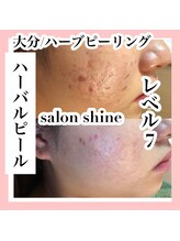 サロンシャイン(Salon Shine)/ハーブピーリング1回