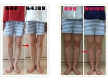 あかり整体の雰囲気（Ｏ脚矯正：3回目のビフォーアフター。変化には個人差があります）
