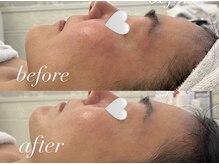 ミランサ ギンザ(MIRANSA GINZA)/【B/A】レストセルフェイシャル