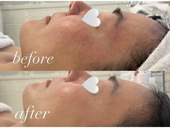 ミランサ ギンザ(MIRANSA GINZA)/【B/A】レストセルフェイシャル