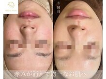 サロンドレナ 名駅店/ハーブピーリング サロンドレナ