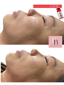 フォトビズ/レッドショット輪郭Vライン小顔