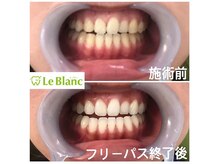 ルブラン 奈良店(Le Blanc)/春に向けてホワイトニングを