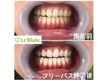 ルブラン 奈良店(Le Blanc)/春に向けてホワイトニングを