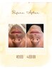 【好評につき☆今だけ価格】清潔感UPヒゲ脱毛☆ ¥7700 → ¥3300