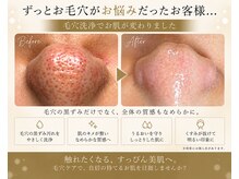 ムーン 高崎店(MOON)の雰囲気（毛穴洗浄最新マシンポアジェットプロ）