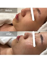 ココ(Coco)/美白・トーンアップ施術