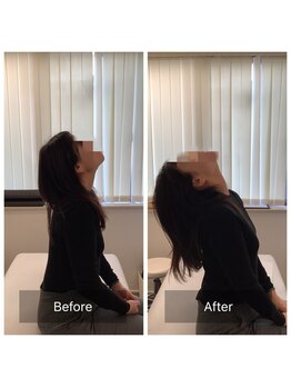 ナオル整体 新宿院(NAORU整体)/30代女性-姿勢矯正1ヶ月経過