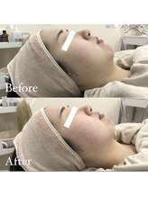 メゾンリュバン 梅田店(Maison Ruban)/脂肪撃退アンプル導入｜小顔