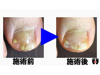 立川巻爪補正院/割れ爪補正 術前・術後
