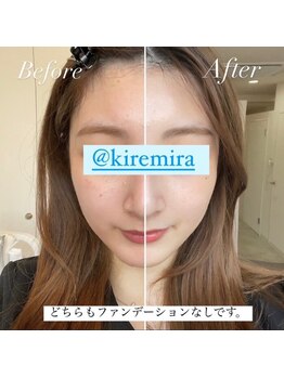 キレミラ 麻布十番店/ハーブピーリングbefore/after