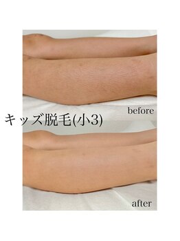 ベル(Belle)/キッズ脱毛（小３）