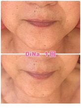 ミレボ(Me.rebo)/水光ケアのB→A