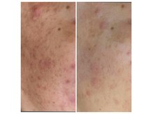 プラズマニキビケア１回　アクネ菌を除去してお肌の土壌を改良！