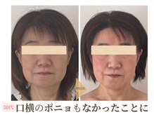 エソア(esoa)/50代　小顔矯正