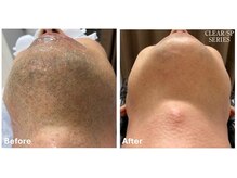 シフォン(Chiffon)/髭脱毛　before★after　2