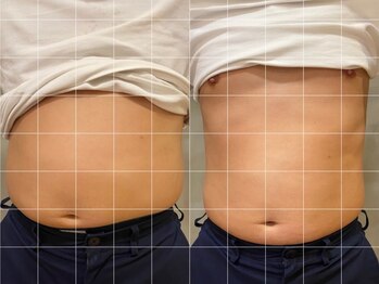 リテルナ(Re.terna)/■脂肪分解溶液注入+マッサージ