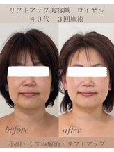 めい鍼灸院/リフトアップ美容鍼