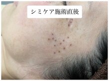 ヌー 栄(nuu)/シミケア