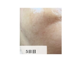 ラビエス(LAVIES)/施術５日目