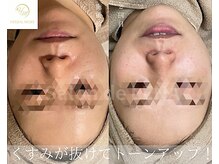 サロンドレナ 名駅店/ハーブピーリング サロンドレナ