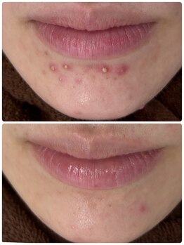 プログレス(PROGRESS)/ニキビケア