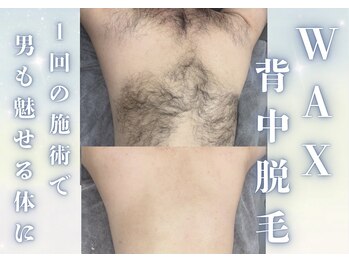 アルゴ 金沢増泉店(ALGO)/【メンズ背中脱毛】