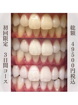 ブリエ(BRILLER)の写真/歯科取扱のホワイトニングで「圧倒的な効果」に感動を！本気で白くしたい方はブリエにお任せ下さい♪